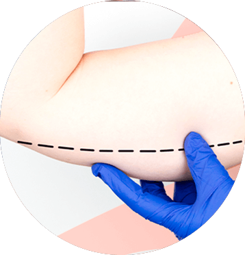 michelle-figueiredo-abdominoplastia-elipse