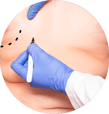 michelle-figueiredo-ginecomastia-elipse