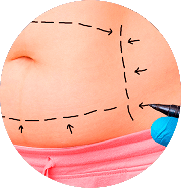 michelle-figueiredo-abdominoplastia-elipse