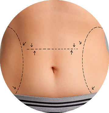 michelle-figueiredo-abdominoplastia-elipse
